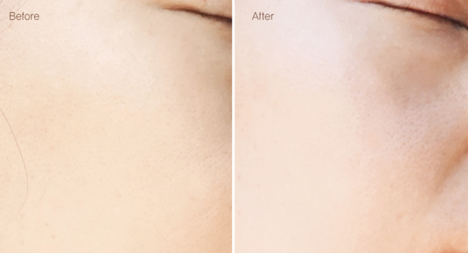 Tẩy da chết hóa học đang là xu hướng làm đẹp thời gian gần đây